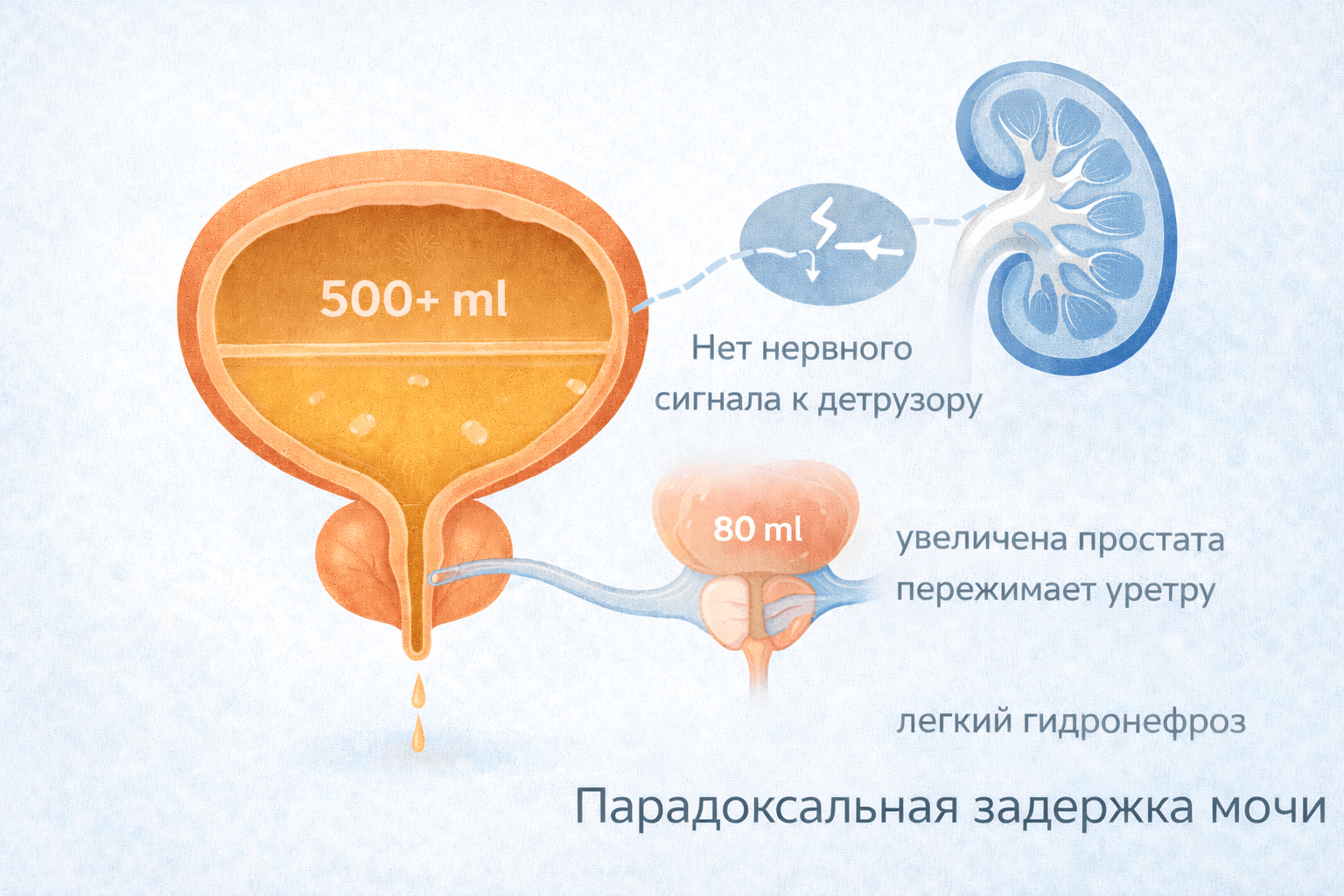 Парадоксальная ишурия.